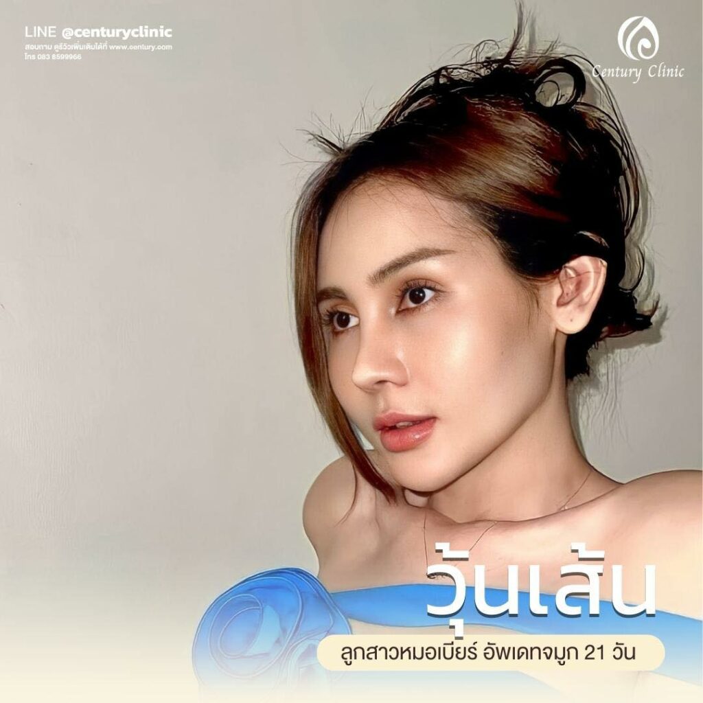 Century-รีวิว-เสริมจมูก 1#593