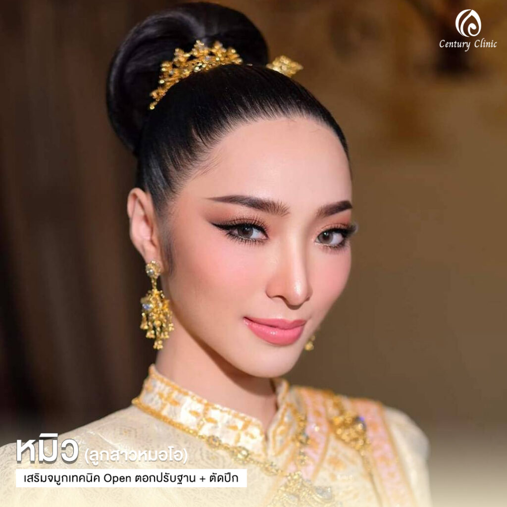 Century-รีวิว-เสริมจมูก 1#600