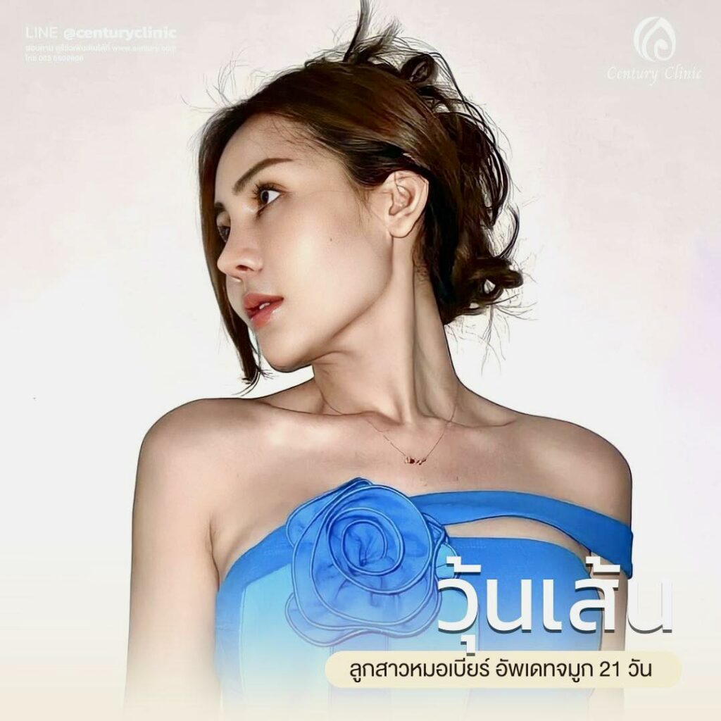 Century-รีวิว-เสริมจมูก 2#593