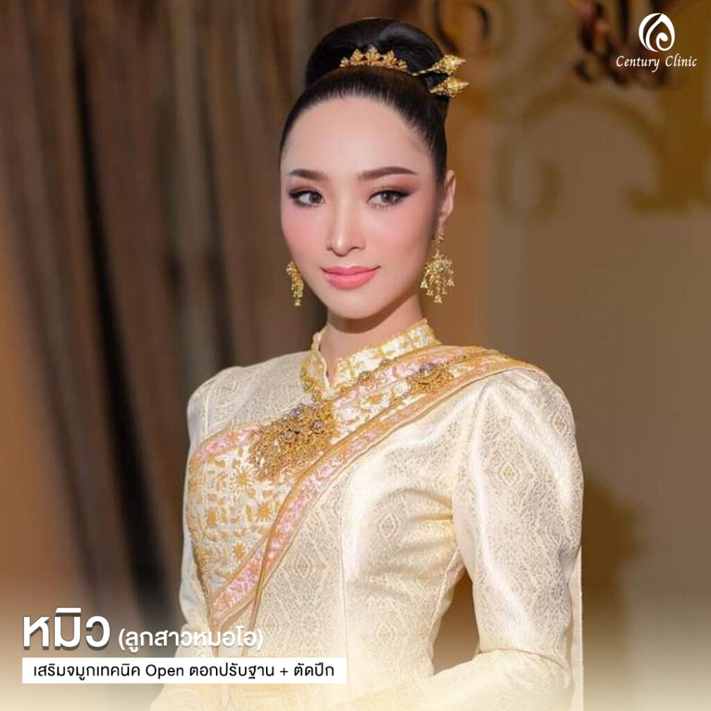 Century-รีวิว-เสริมจมูก 2#600