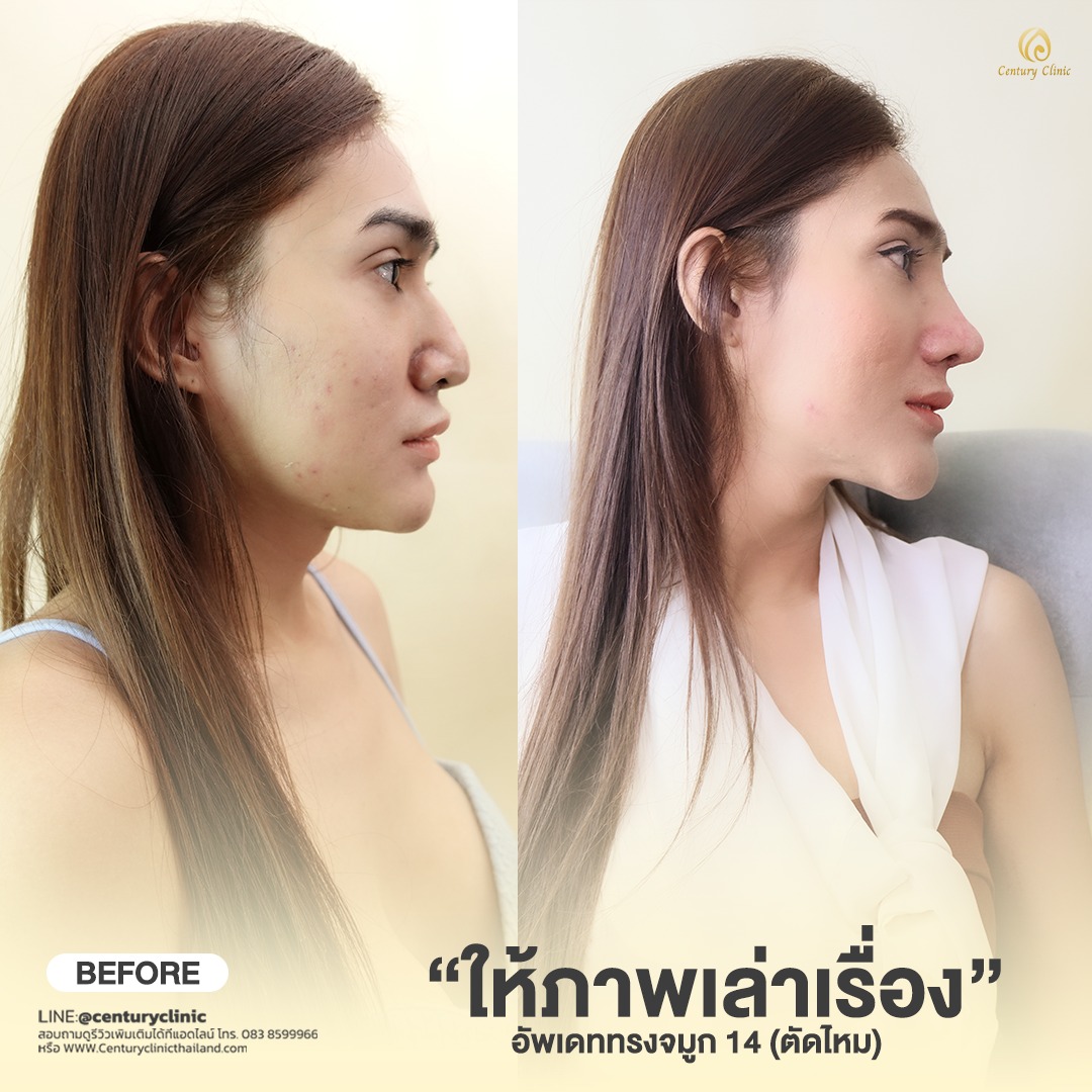 Century-รีวิว-เสริมจมูก #583