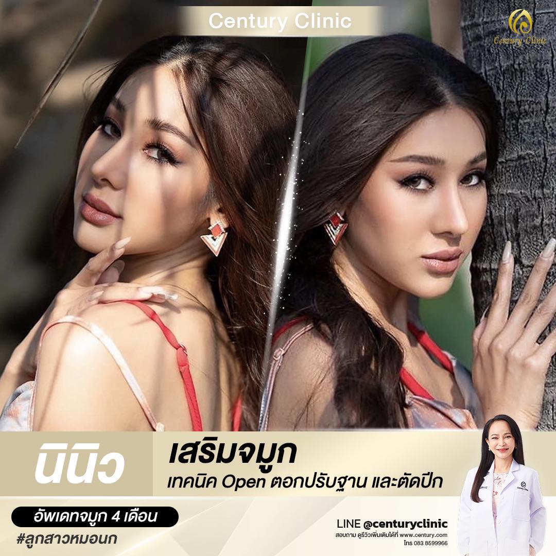 รีวิว เสริมจมูก #594 , Century Clinic Thailand Century-รีวิว-เสริมจมูก #594