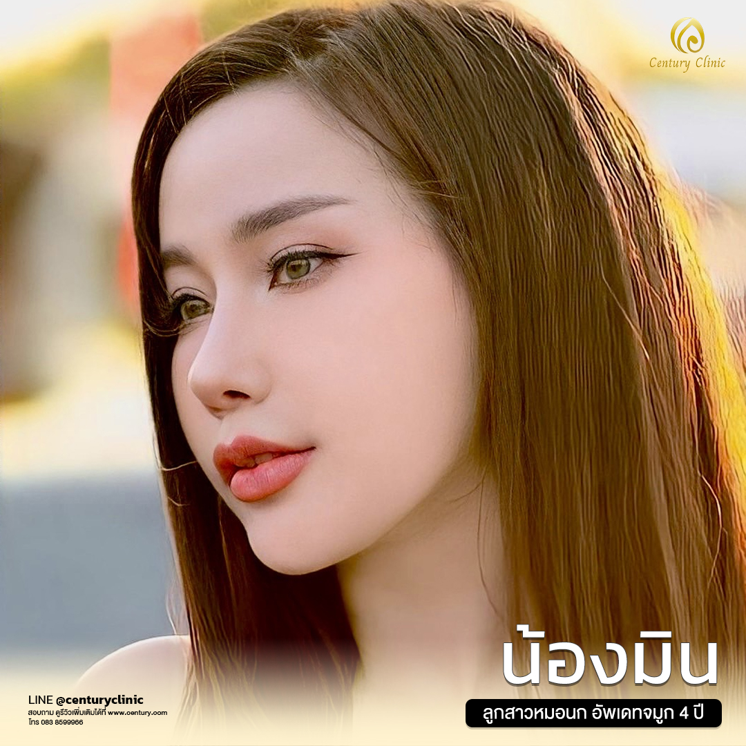Century-รีวิว-เสริมจมูก #608
