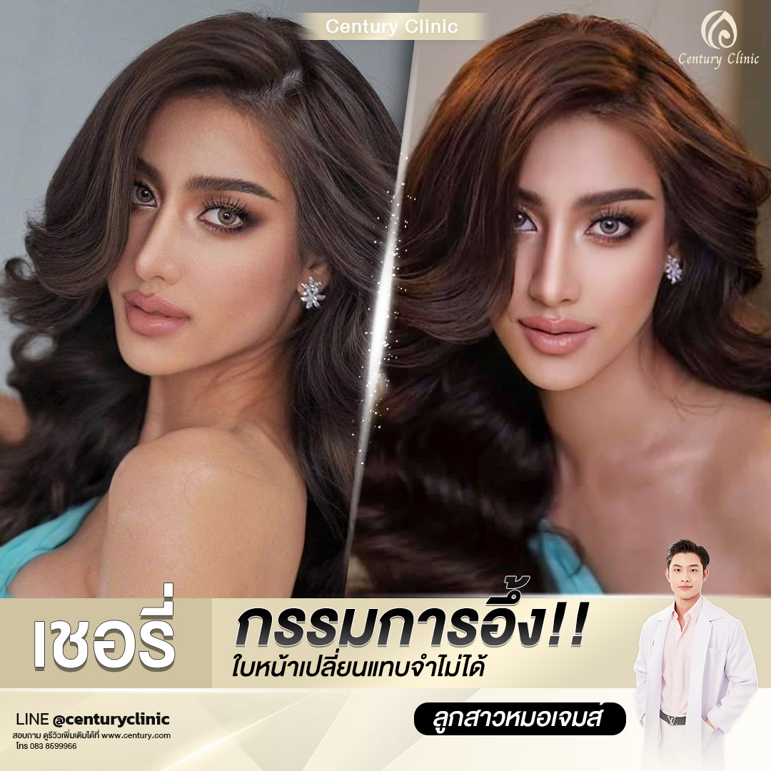 Century-รีวิว-เสริมจมูก #609