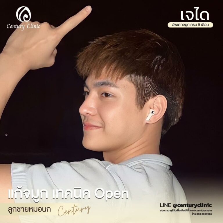 Century-รีวิว-แก้จมูก #612