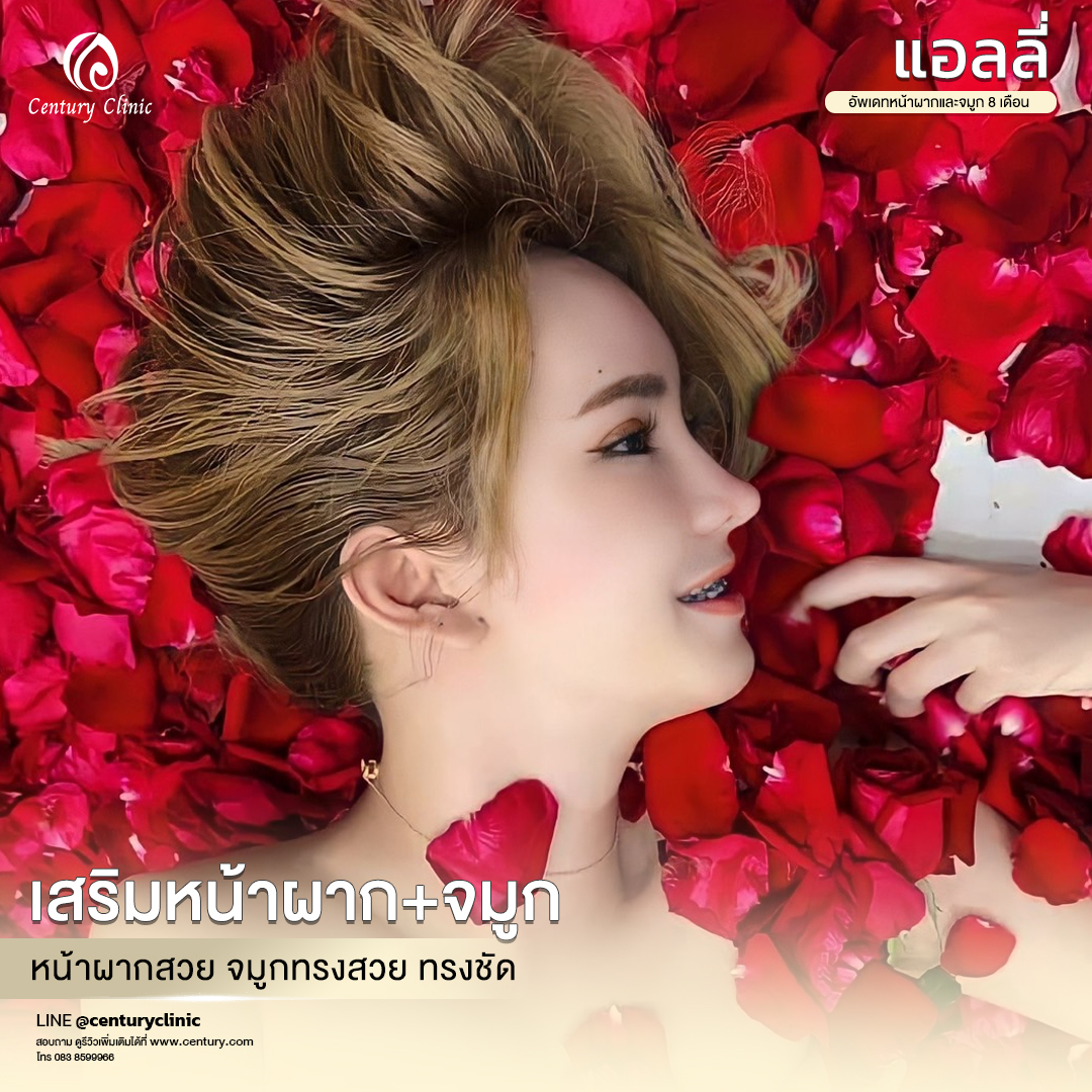 Century-รีวิว-เสริมจมูก #619