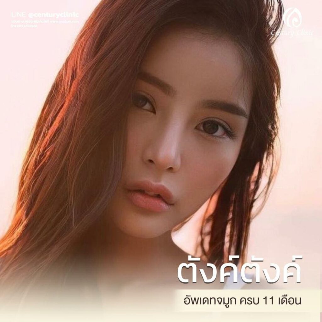 รีวิว แก้จมูก #584 , Century Clinic Thailand Century-รีวิว-แก้จมูก 2#584