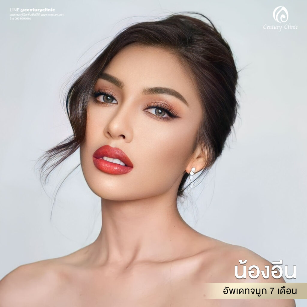 Century-รีวิว-แก้จมูก 2#589