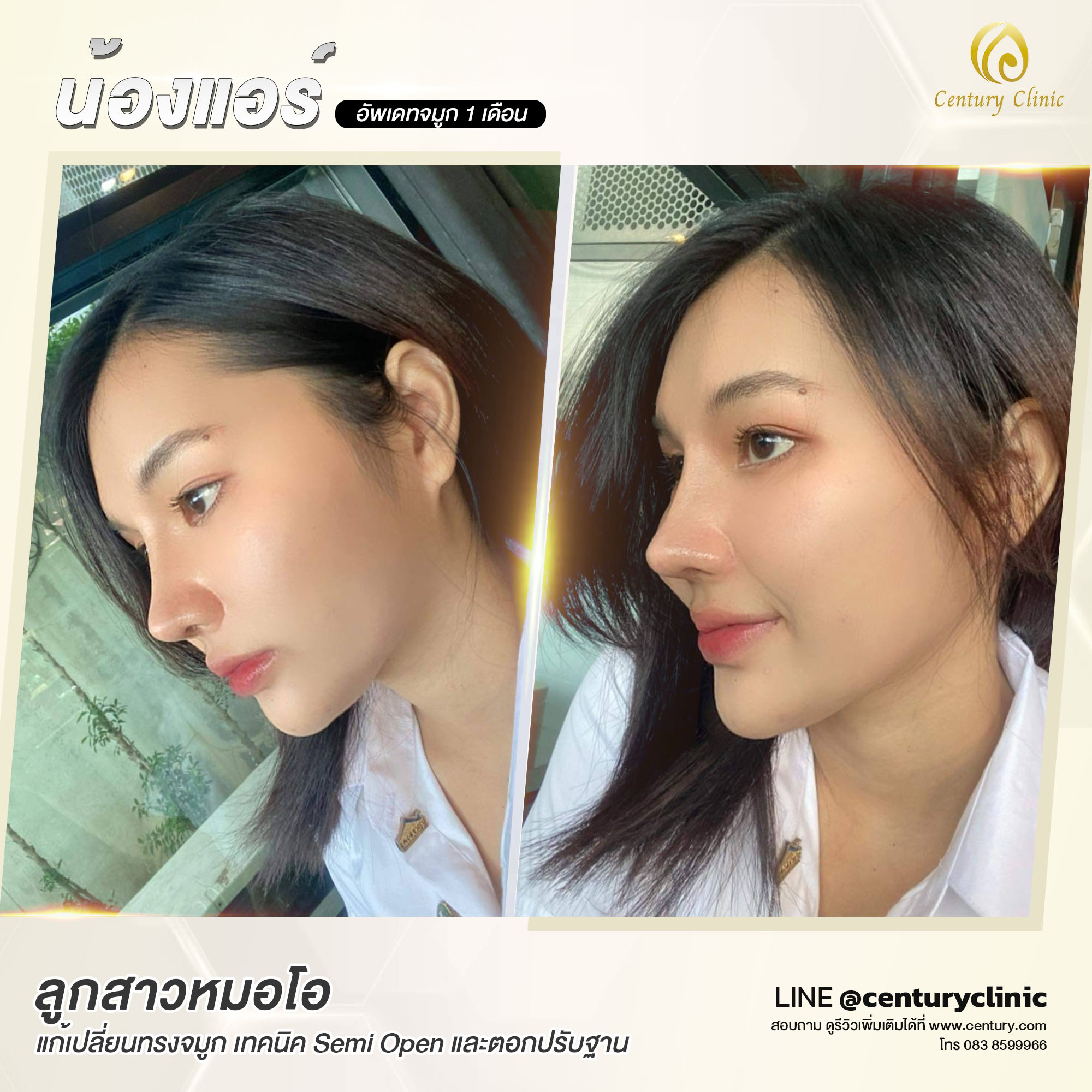 รีวิว แก้จมูก #575 , Century Clinic Thailand Century-รีวิว-แก้จมูก #575