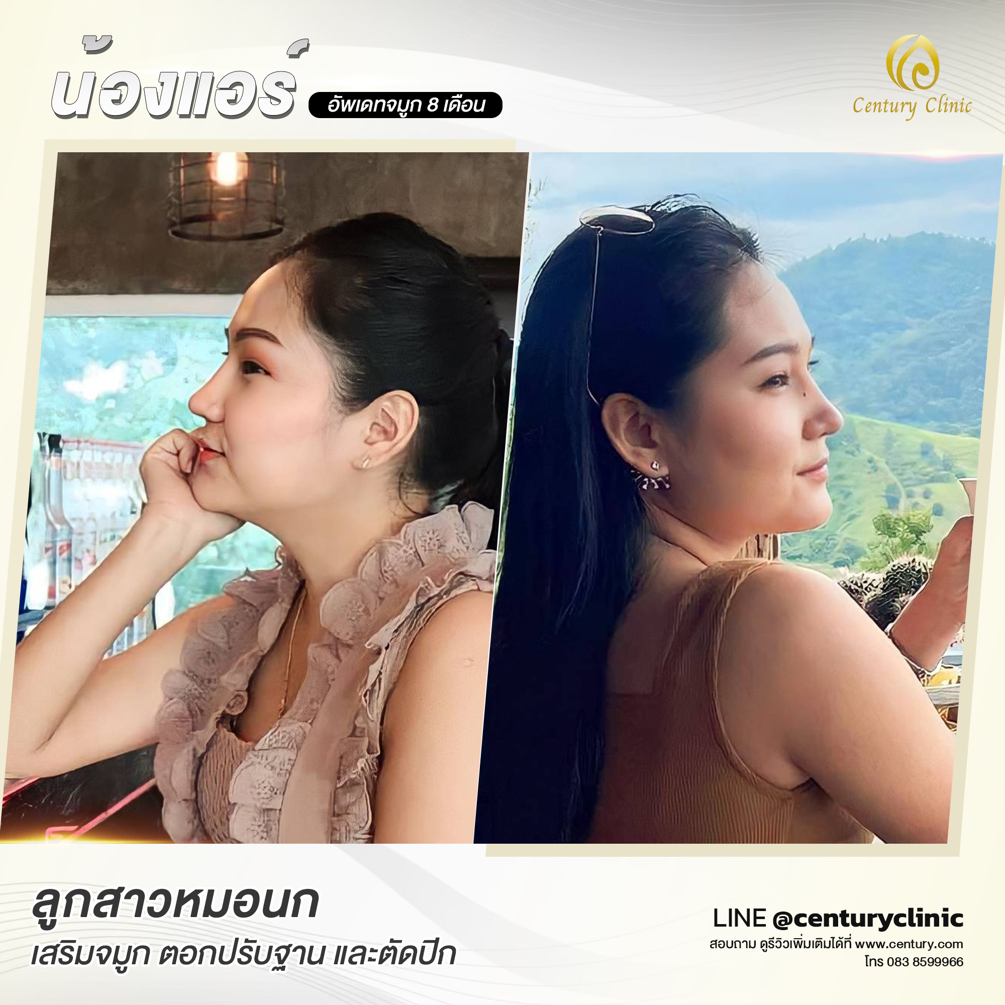 Century-รีวิว-แก้จมูก #580
