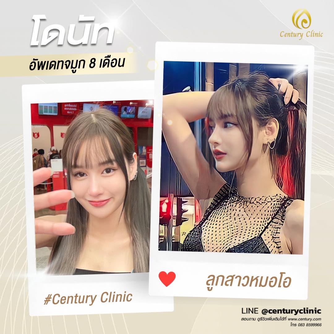 รีวิว แก้จมูก #586 , Century Clinic Thailand Century-รีวิว-แก้จมูก #586