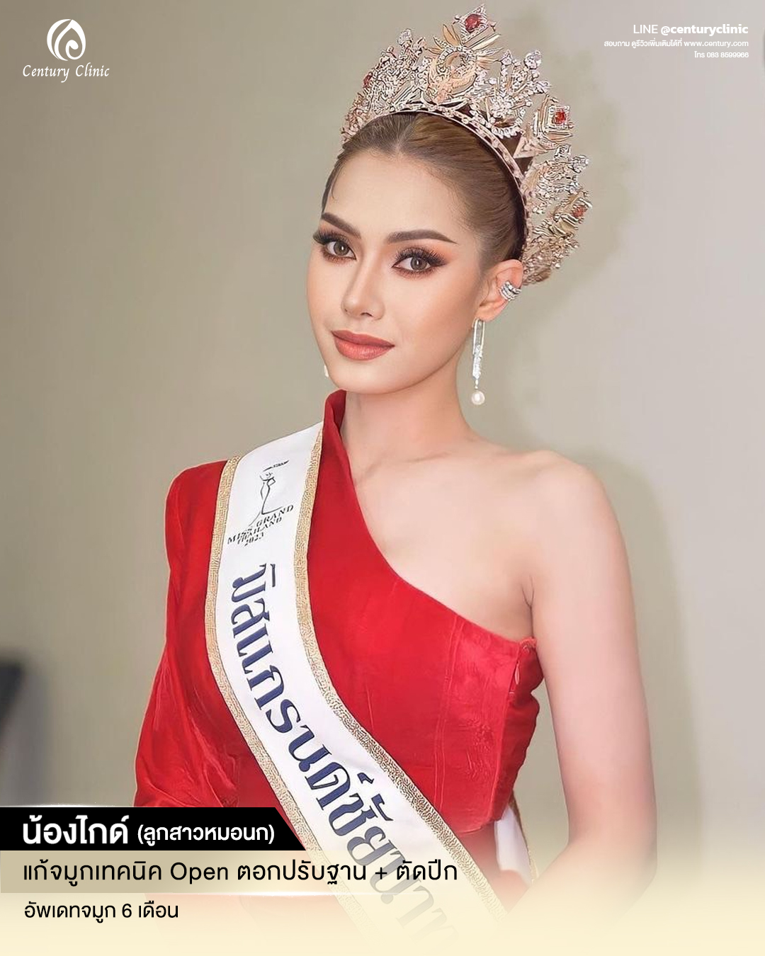 Century-รีวิว-แก้จมูก #595