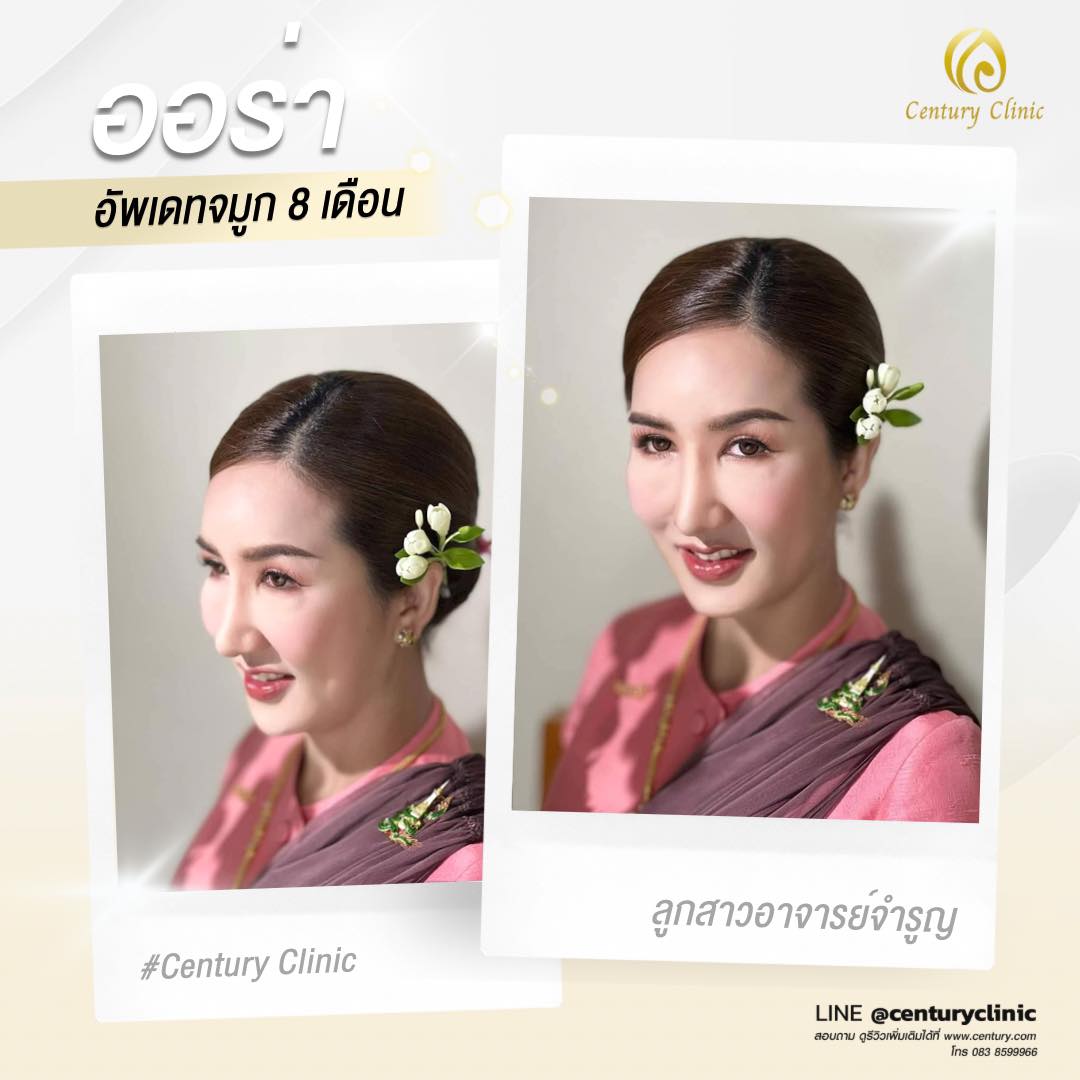 Century-รีวิว-แก้จมูก #596