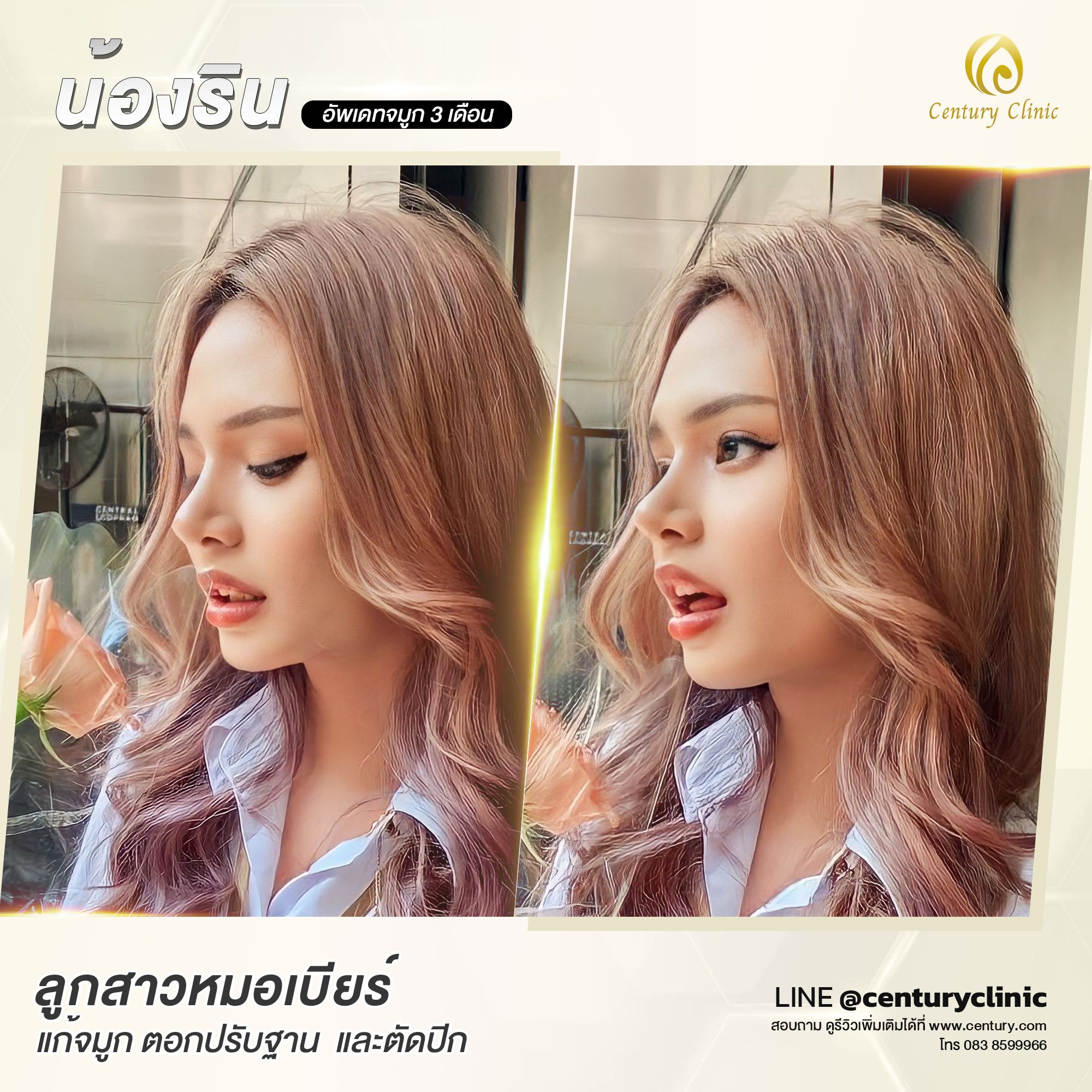 Century-รีวิว-แก้จมูก #602
