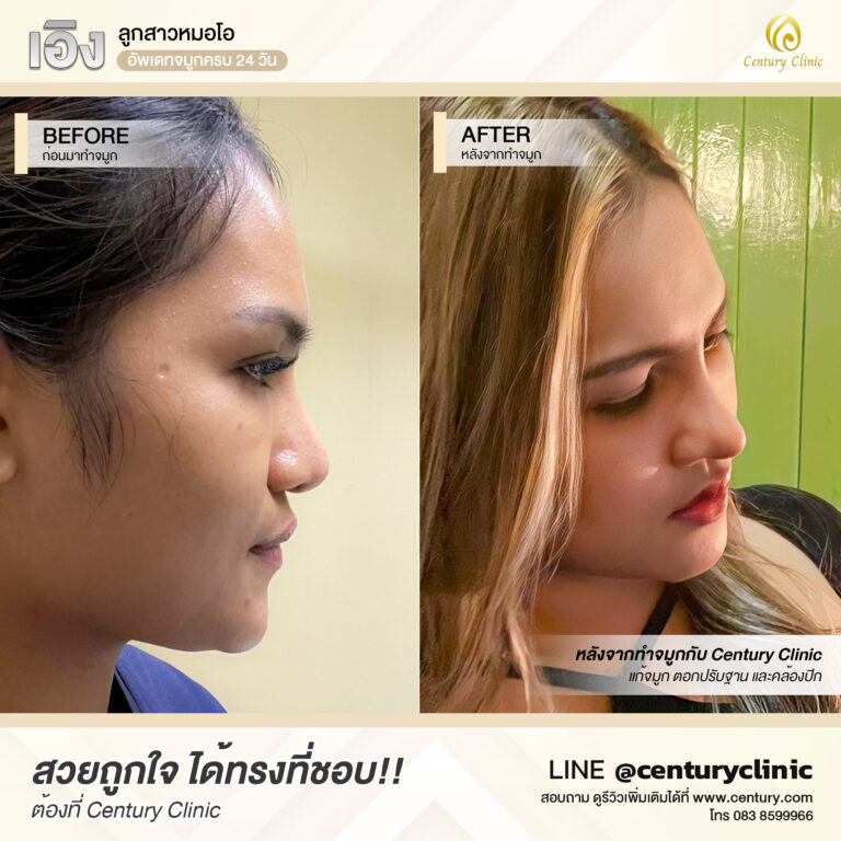 Century-รีวิว-แก้จมูก #604