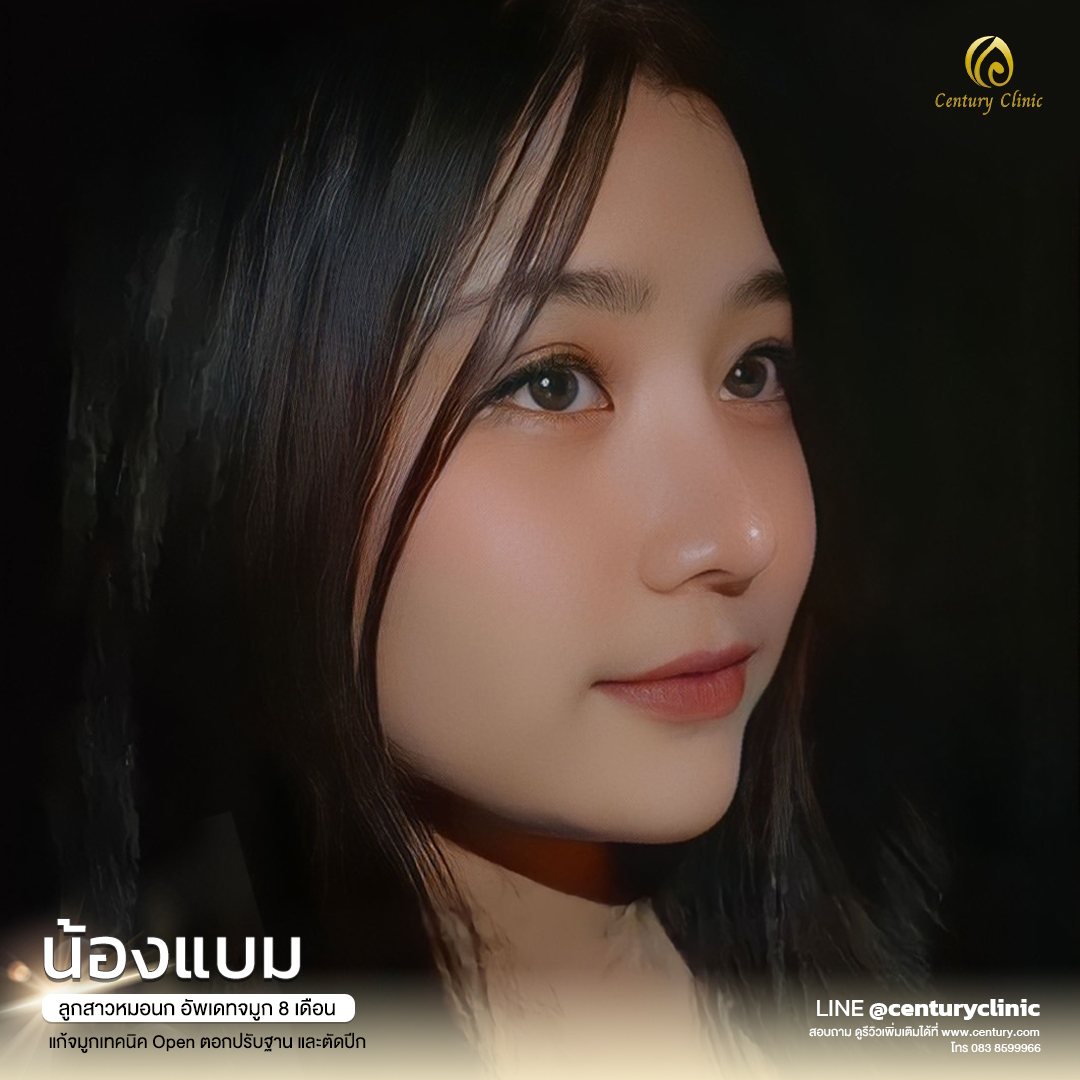 Century-รีวิว-แก้จมูก #606
