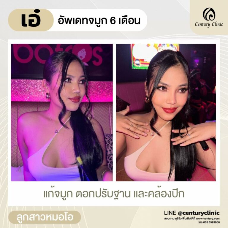 Century-รีวิว-แก้จมูก #613