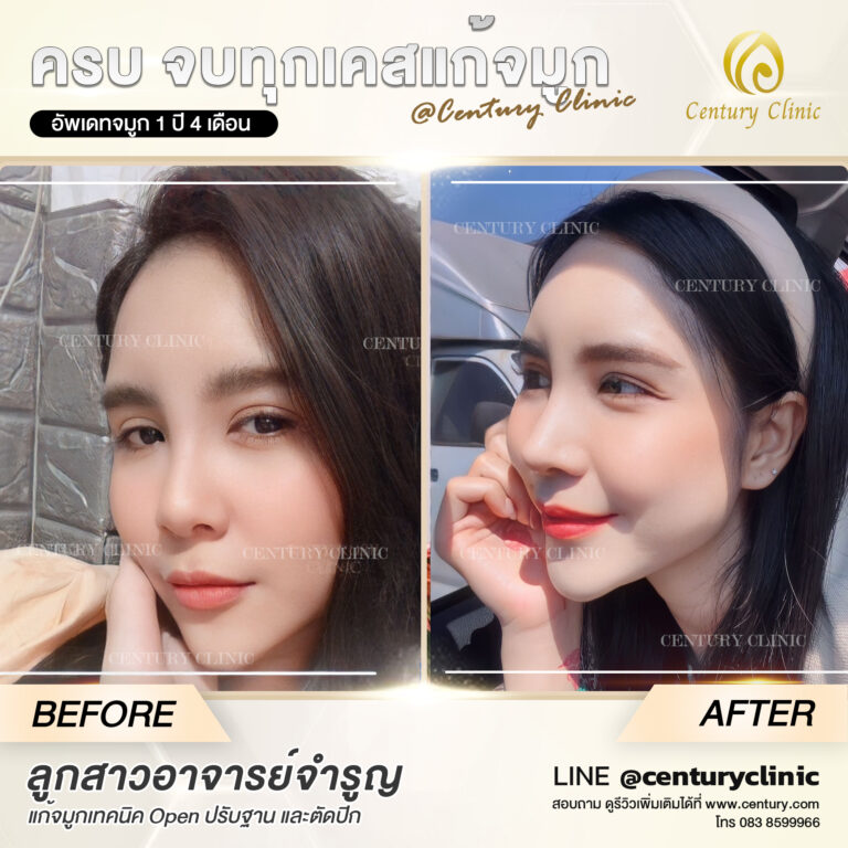 Century-รีวิว-แก้จมูก #615