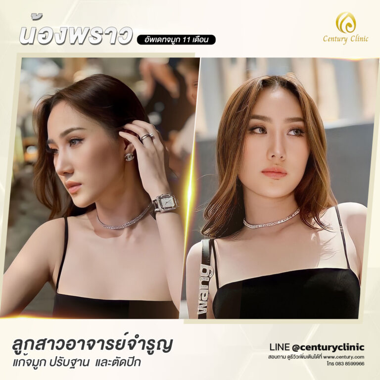 Century-รีวิว-แก้จมูก #616