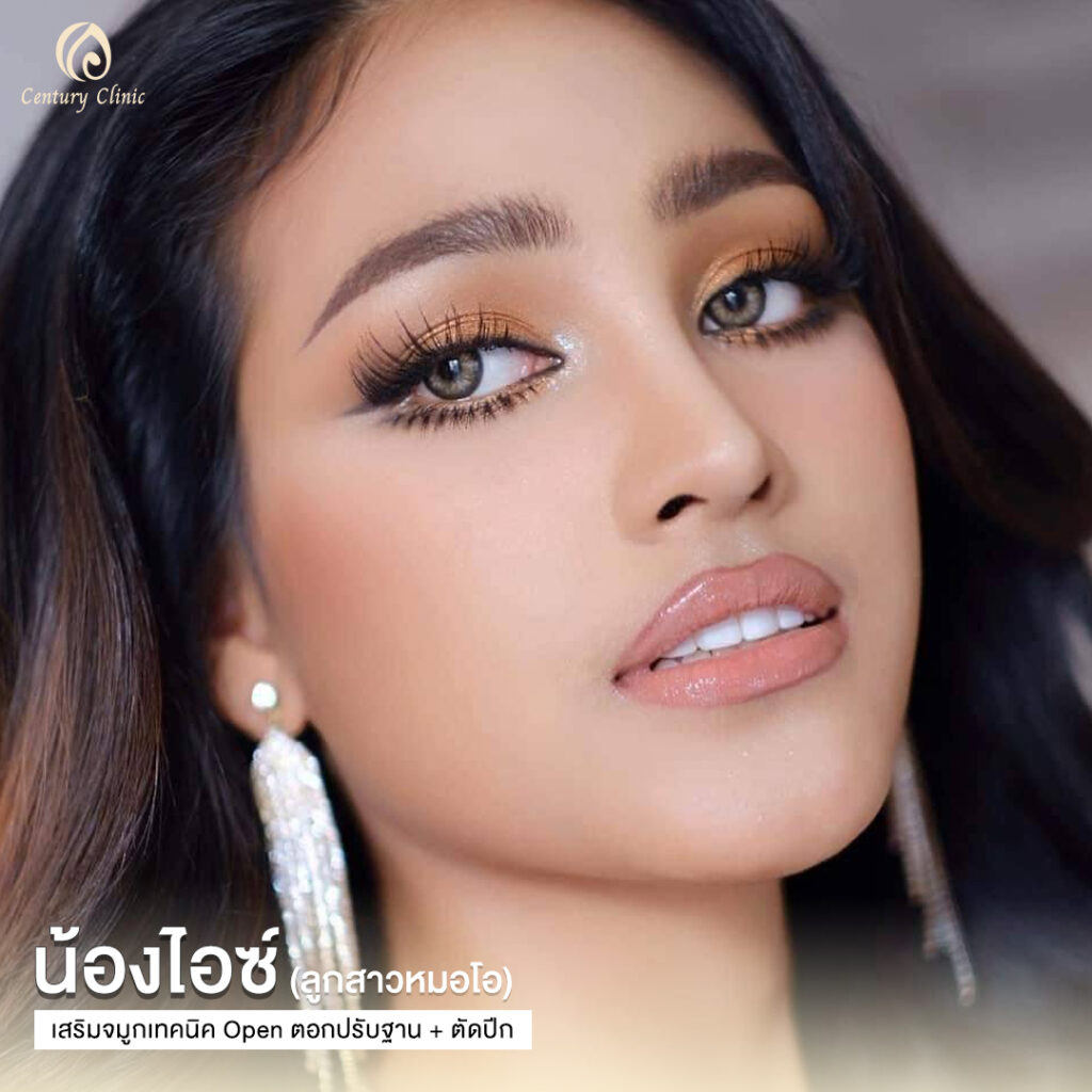 Century-รีวิว-เสริมจมูก 1#639