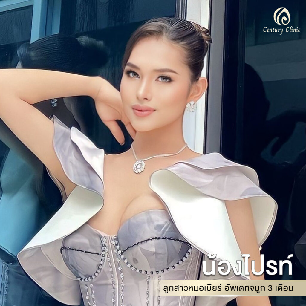 Century-รีวิว-เสริมจมูก 1#642
