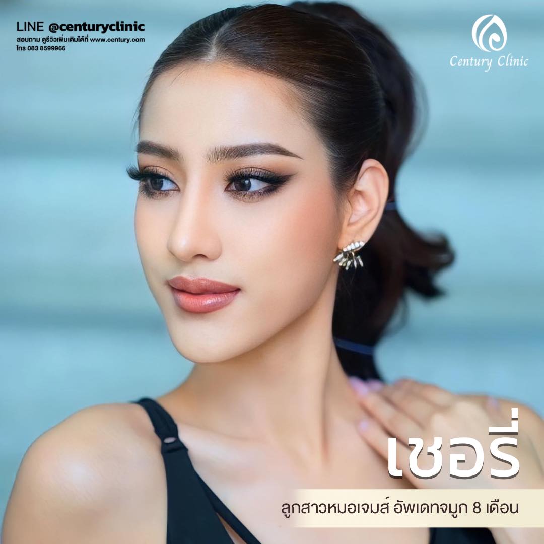 Century-รีวิว-เสริมจมูก #625