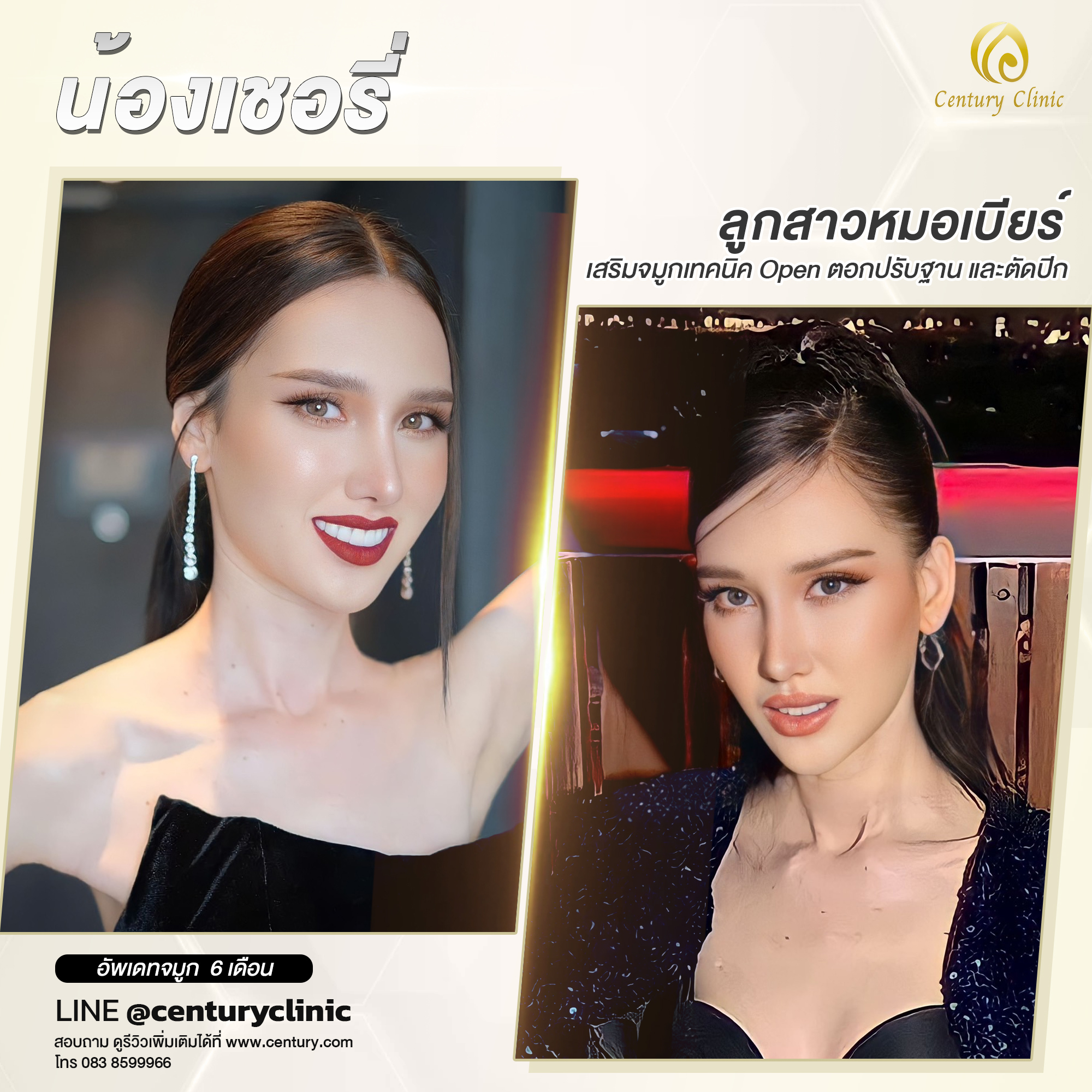 Century-รีวิว-เสริมจมูก #629