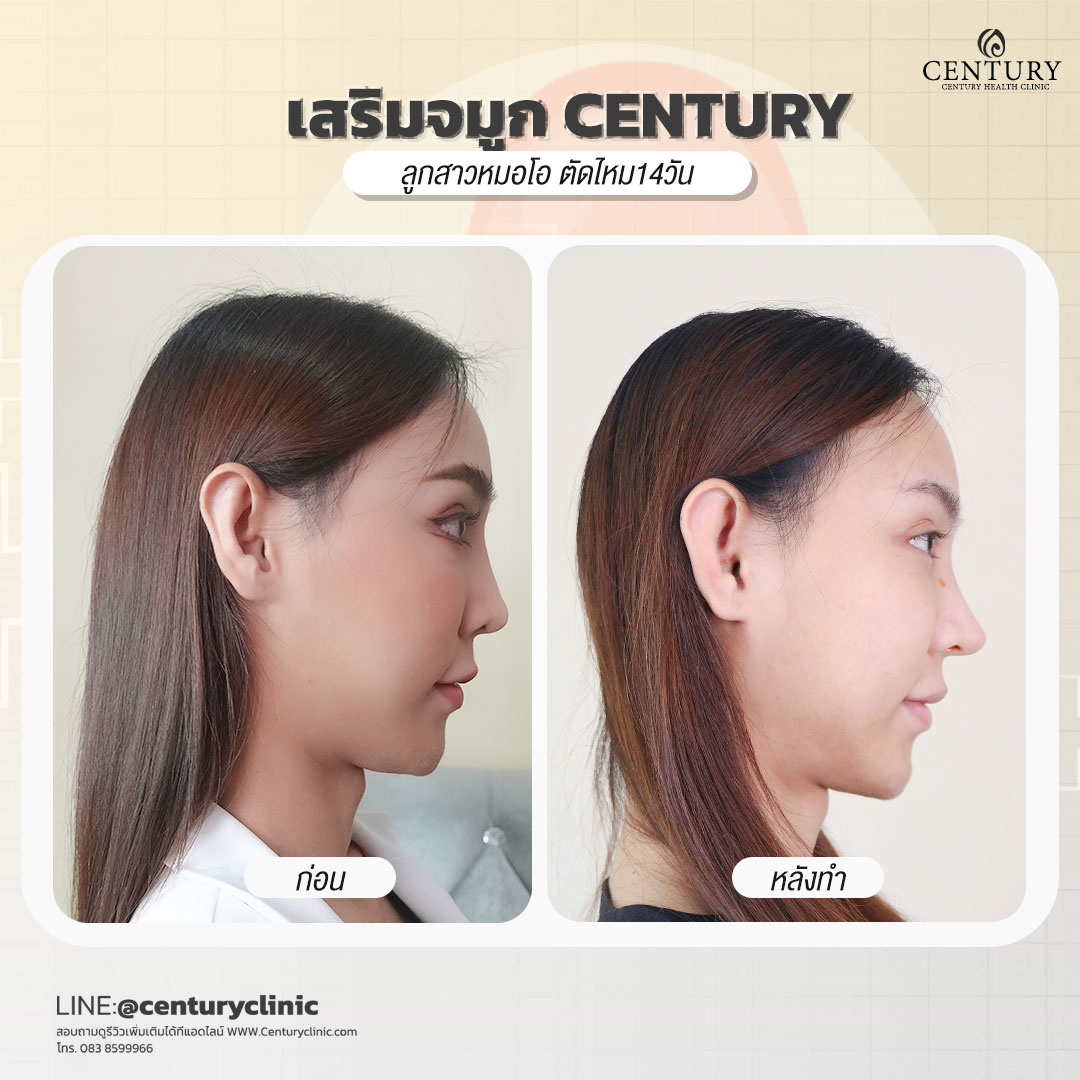 Century-รีวิว-เสริมจมูก #630