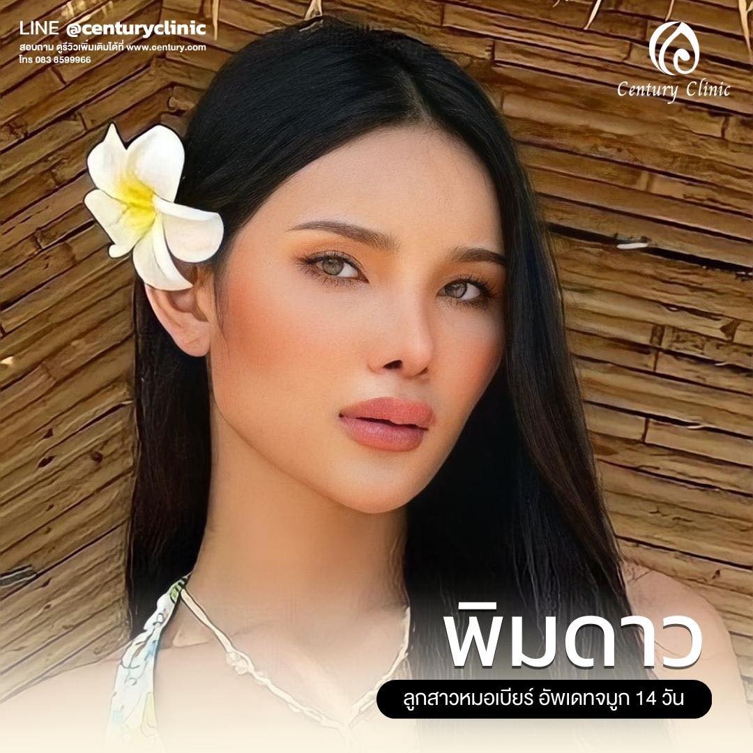 Century-รีวิว-เสริมจมูก #636