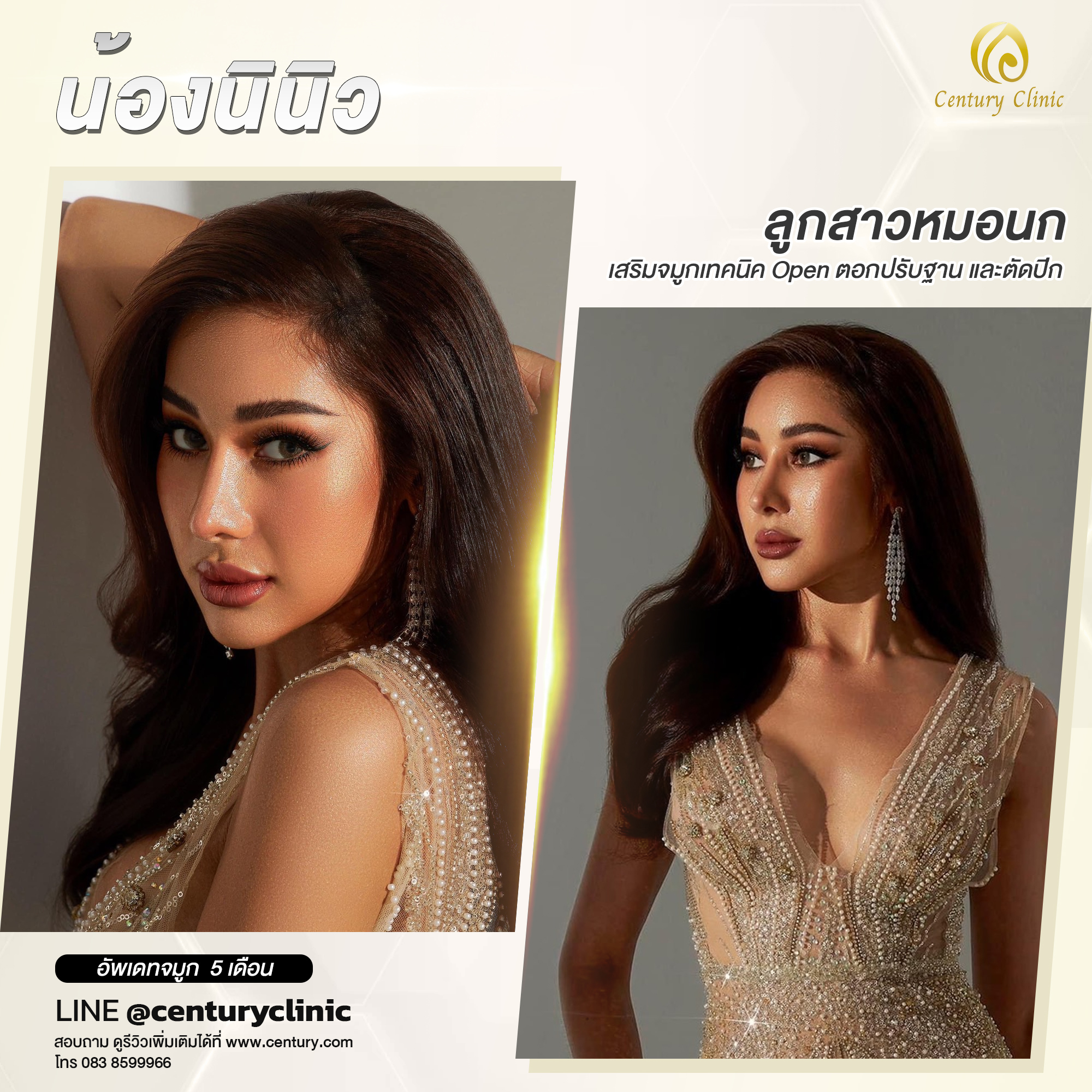 Century-รีวิว-เสริมจมูก #640