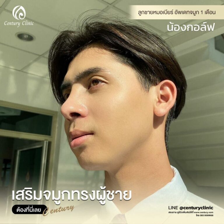 Century-รีวิว-เสริมจมูก #644