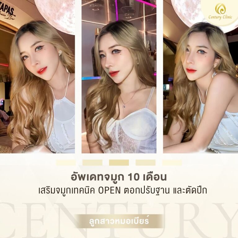 Century-รีวิว-เสริมจมูก #647