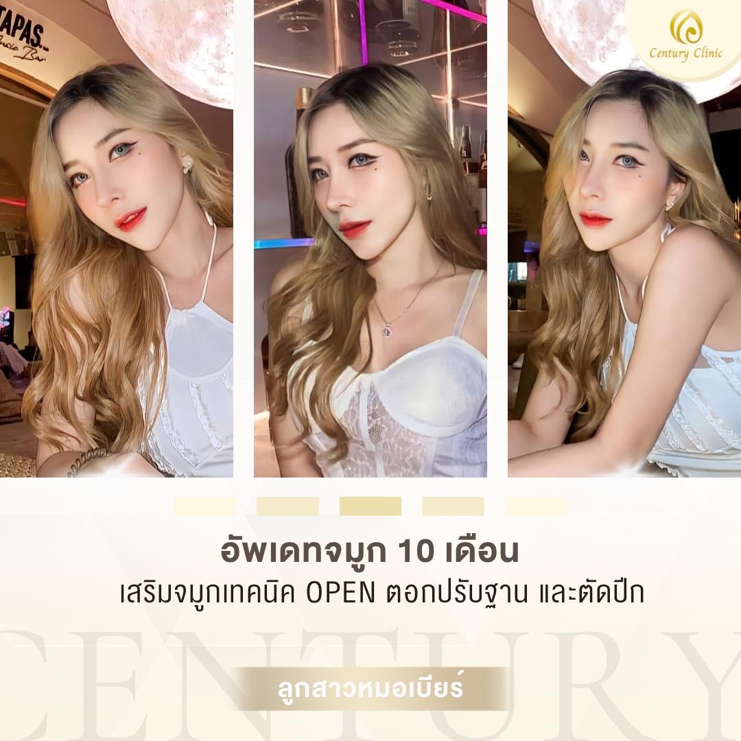 Century-รีวิว-เสริมจมูก #647