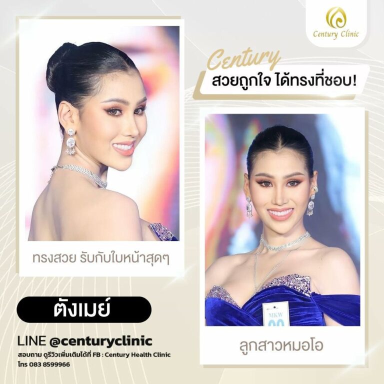 Century-รีวิว-เสริมจมูก #655