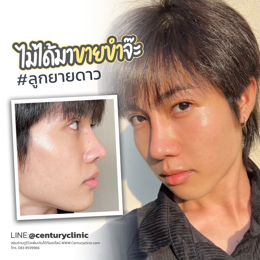 Century-รีวิว-เสริมจมูก #658