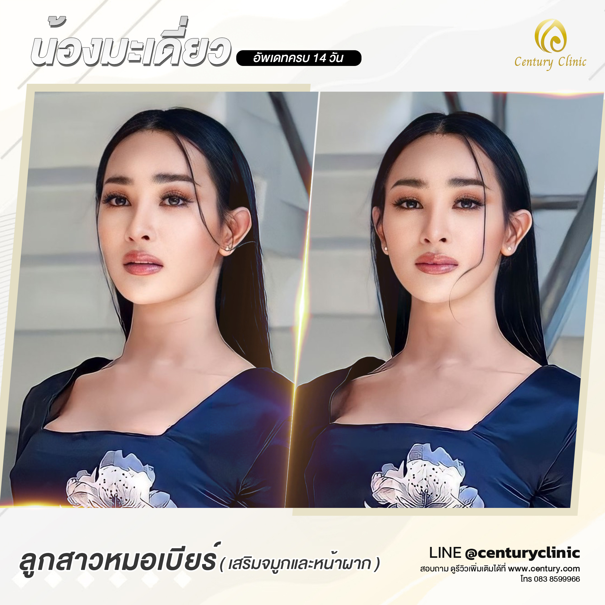 Century-รีวิว-เสริมจมูก-หน้าผาก#643
