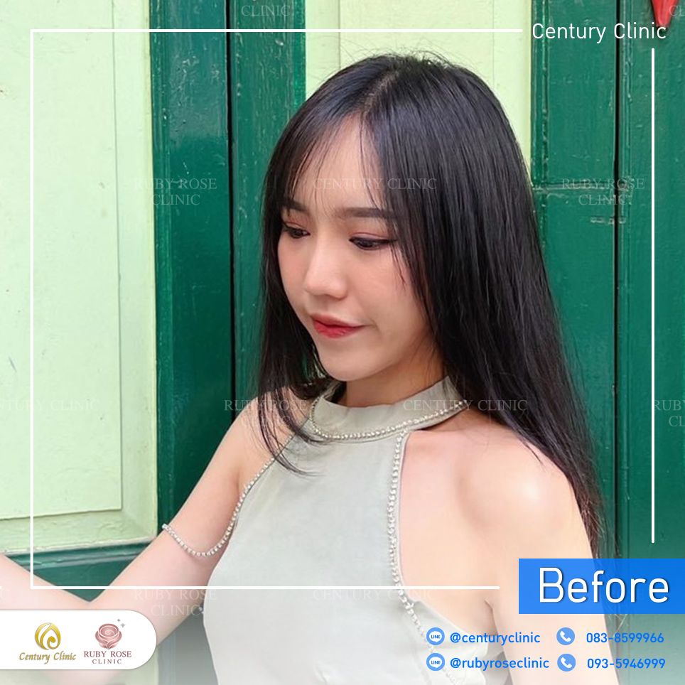 รีวิว แก้จมูก #628 , Century Clinic Thailand Century-รีวิว-แก้จมูก 1#628