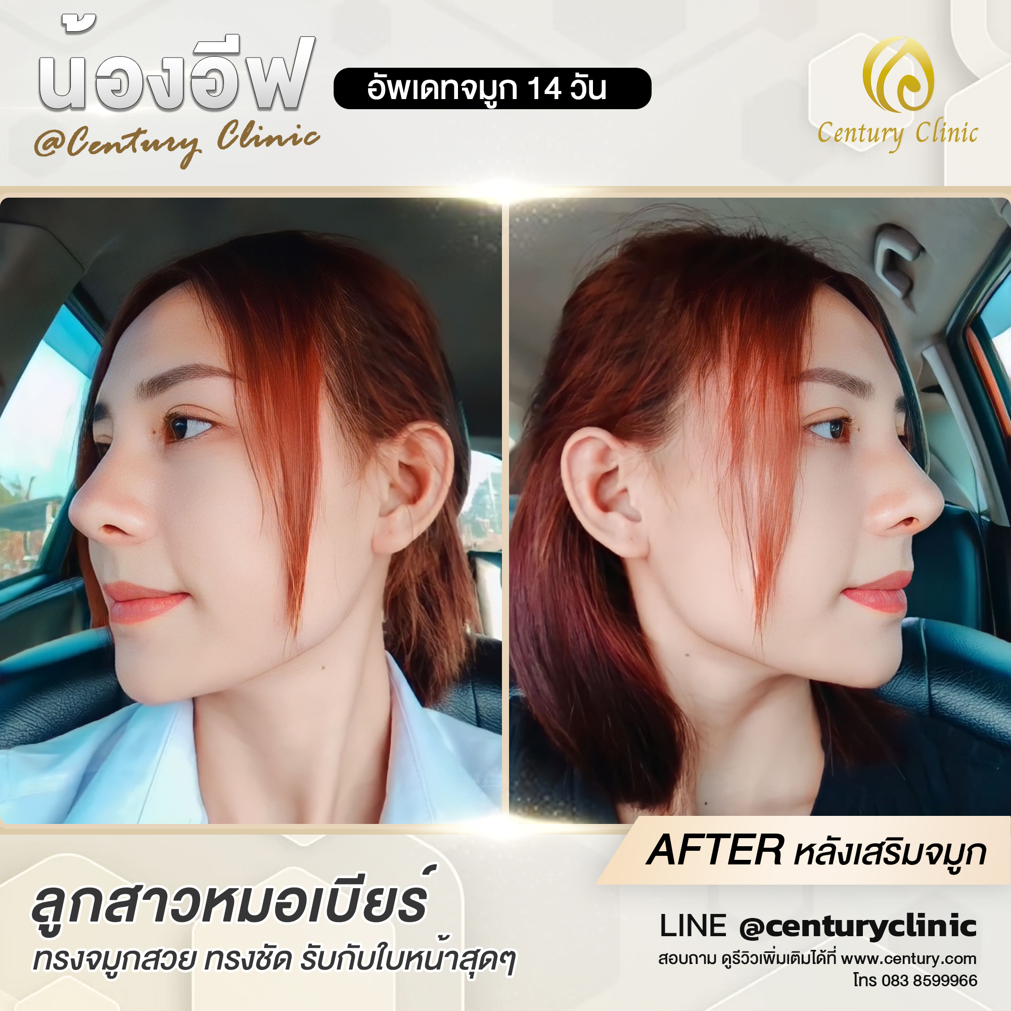 Century-รีวิว-แก้จมูก #635