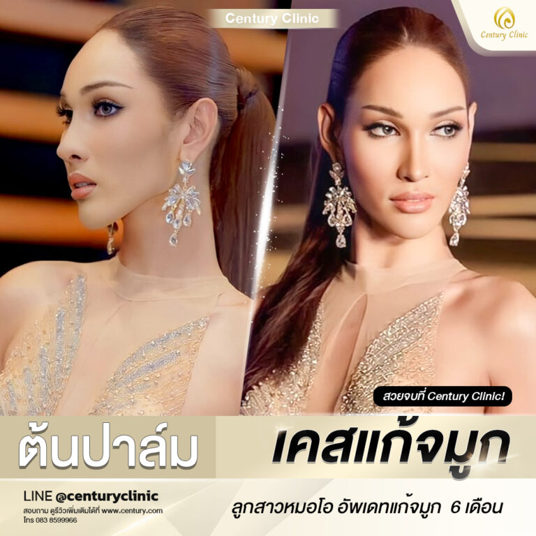 Century-รีวิว-แก้จมูก #648
