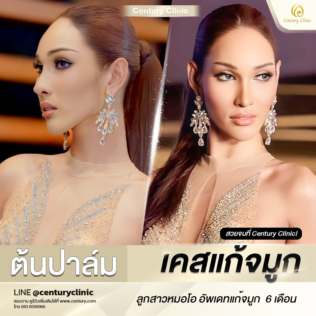 Century-รีวิว-แก้จมูก #648