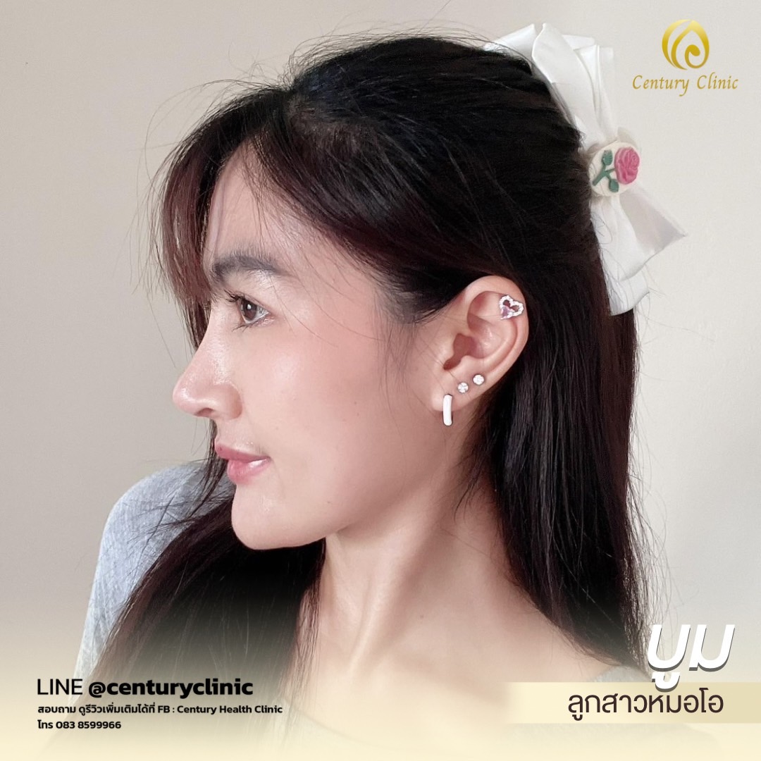 รีวิว เสริมจมูก #660 , Century Clinic Thailand Century-รีวิว-แก้จมูก #660