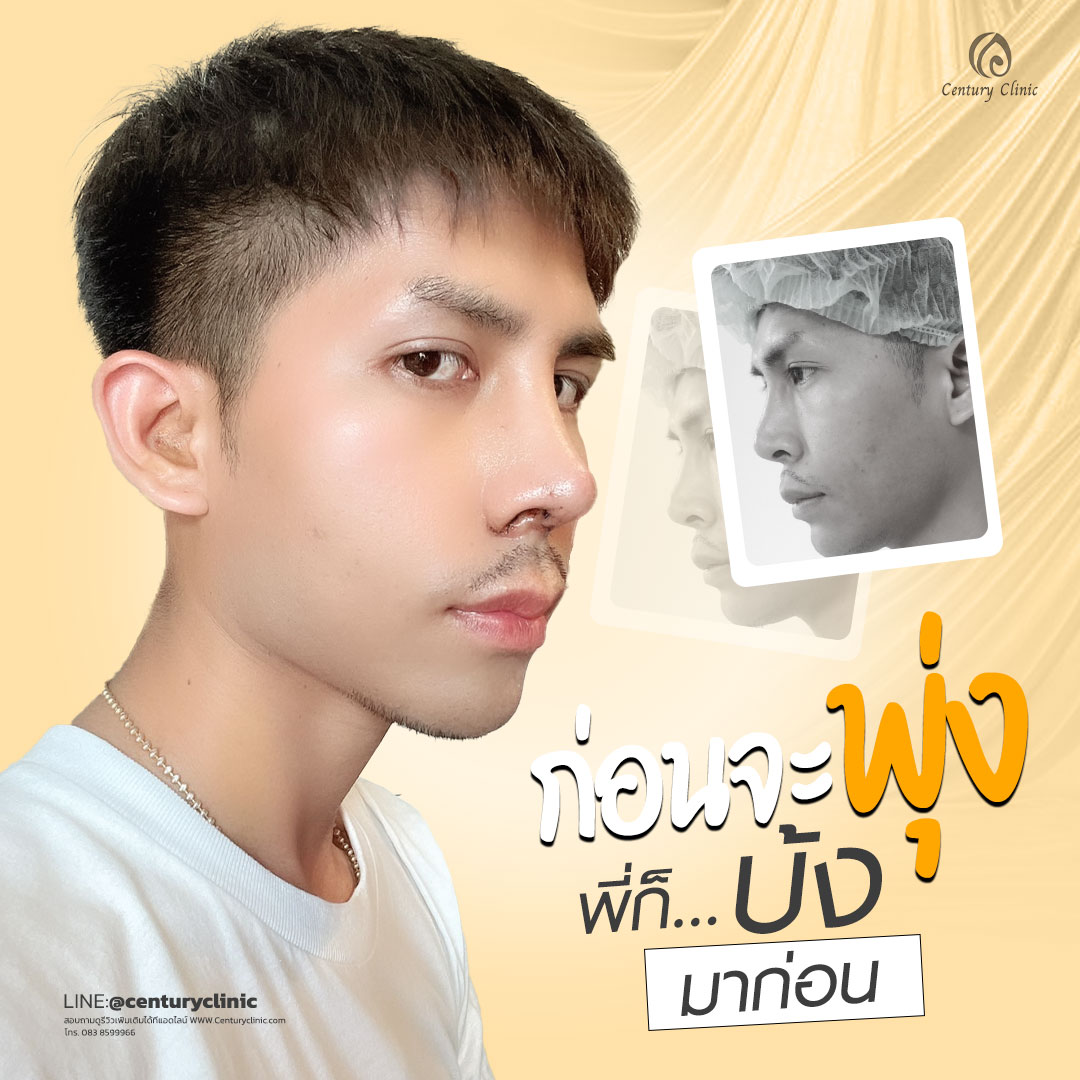 Century-รีวิว-แก้จมูก #661