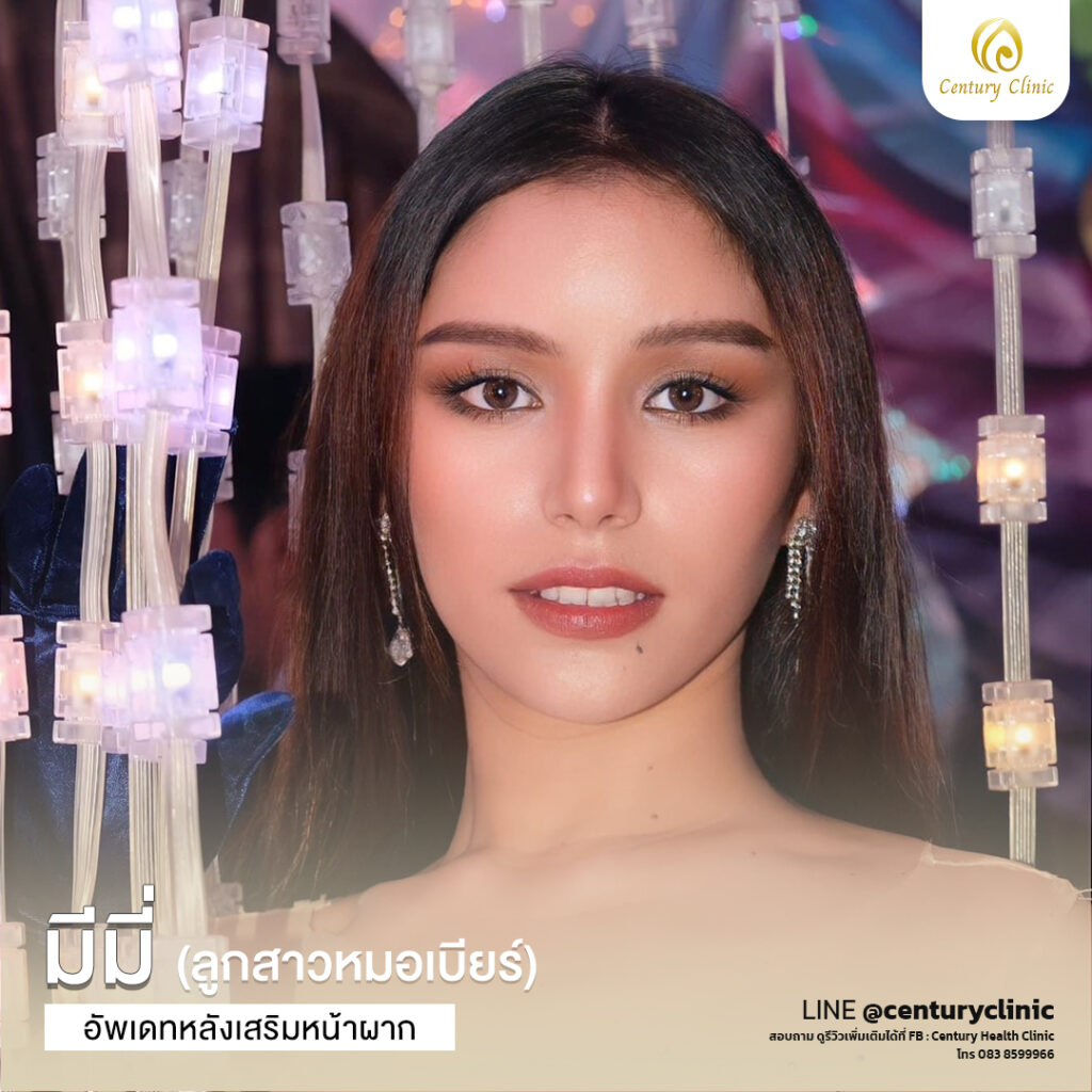 รีวิว แก้หน้าผาก1#23