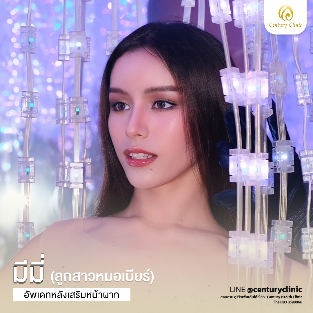 รีวิว แก้หน้าผาก#23