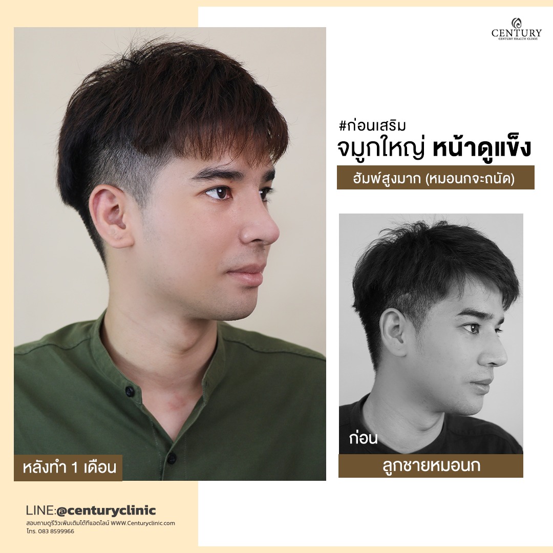 รีวิว เสริมจมูก #672 , Century Clinic Thailand Century-รีวิว-เสริมจมูก #673