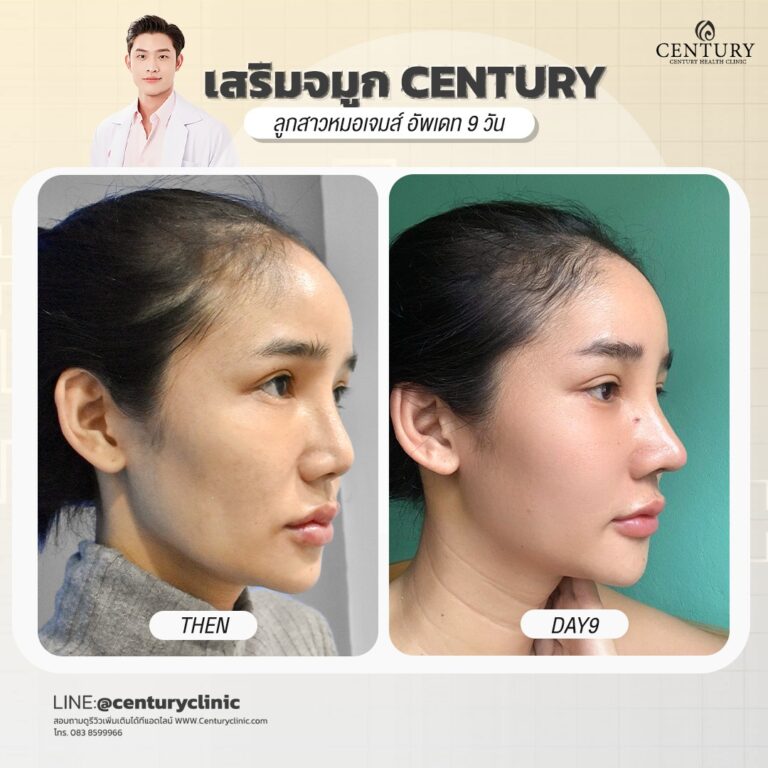 Century-รีวิว-เสริมจมูก #677