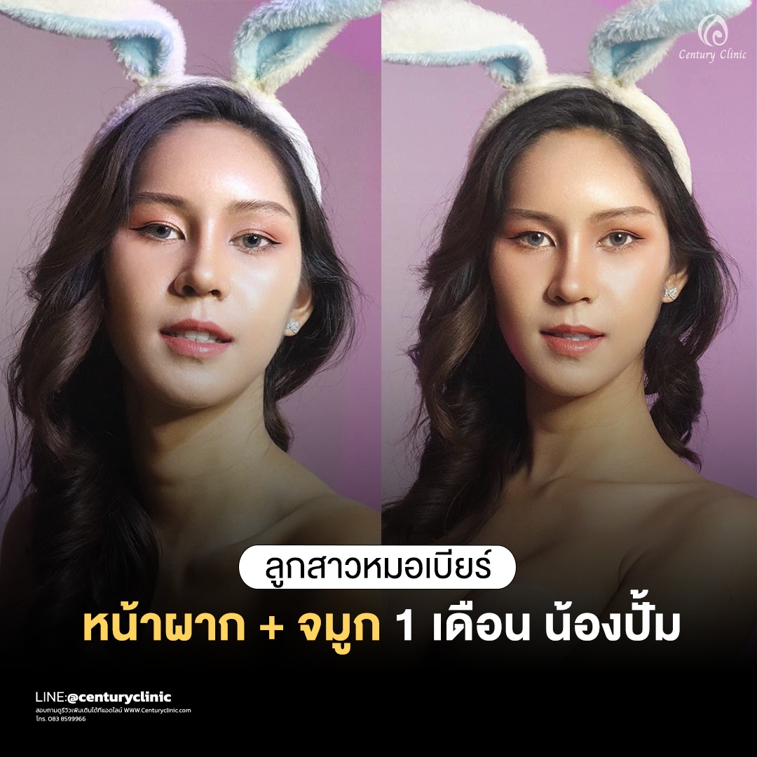 Century-รีวิว-เสริมจมูก #681