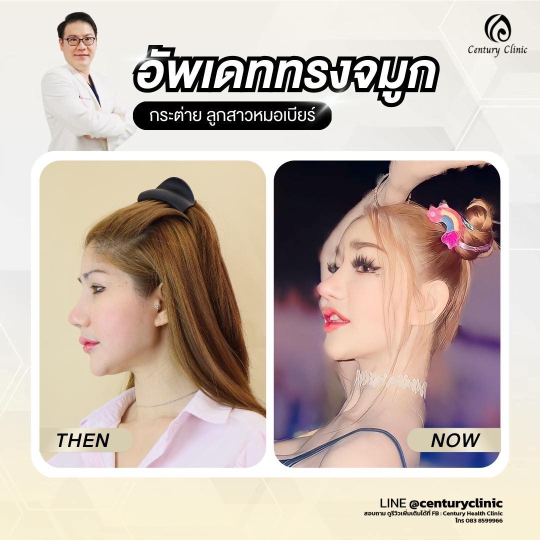 รีวิว เสริมจมูก #686 , Century Clinic Thailand Century-รีวิว-เสริมจมูก #686