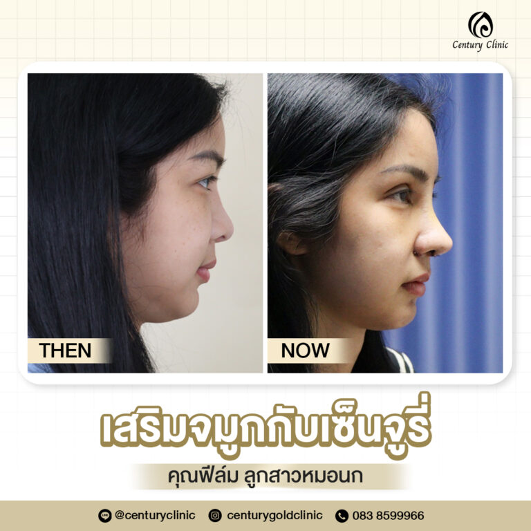 Century-รีวิว-เสริมจมูก #687