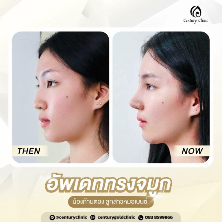 Century-รีวิว-เสริมจมูก #688